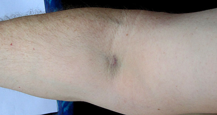 bruise left after
                          blood sample taken