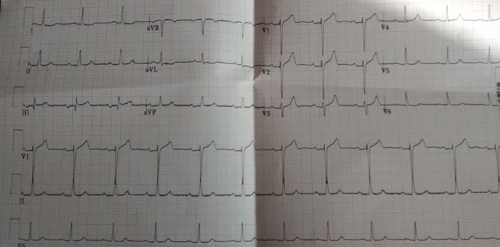 Electro-cardiogram