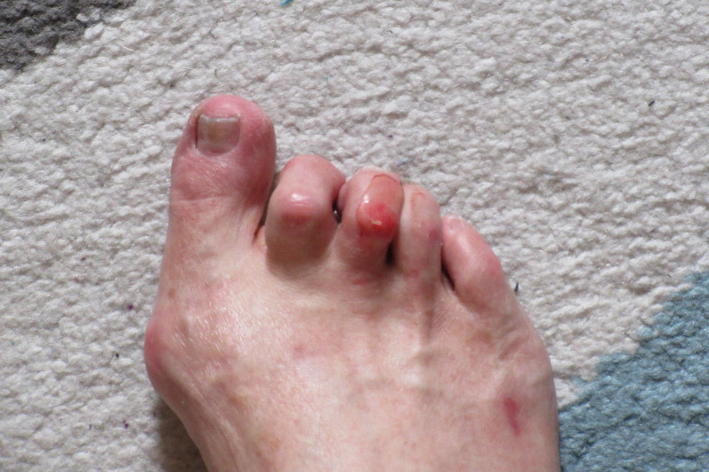 bloody toe