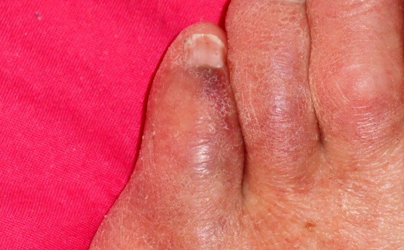 bruised
                                    little toe