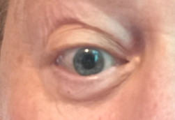 dilated pupil
