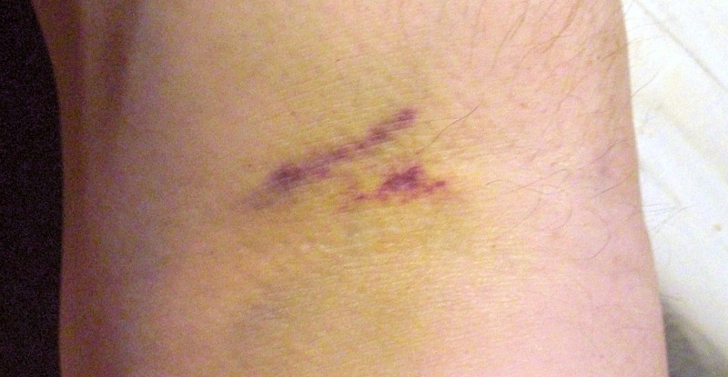 bruising from
                                                      site of blood
                                                      sample