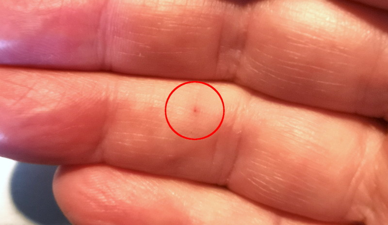 spider bite