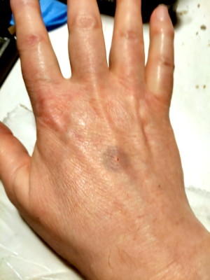 bruise on my hand